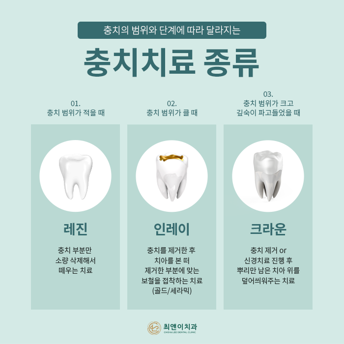 자연치아를 보존하기 위한 충치치료 방법 관련 이미지 5