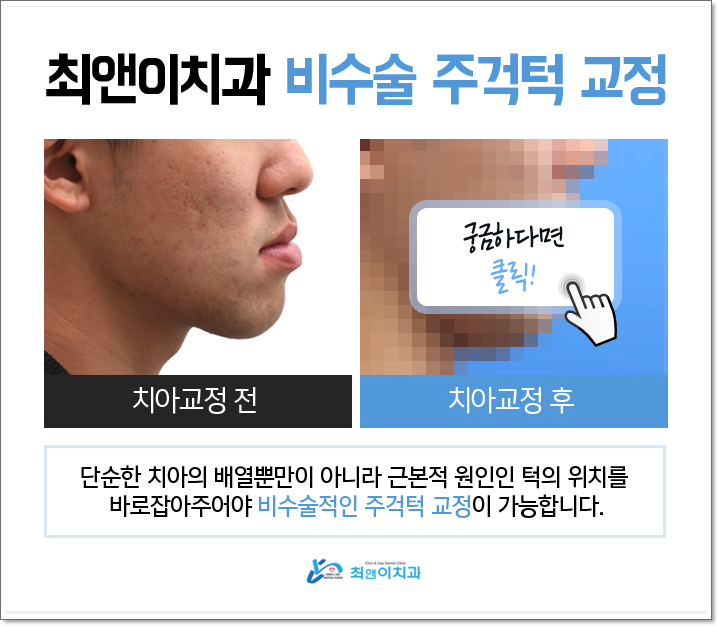 치아턱교정 달라짐이 보이려면 관련 이미지 4
