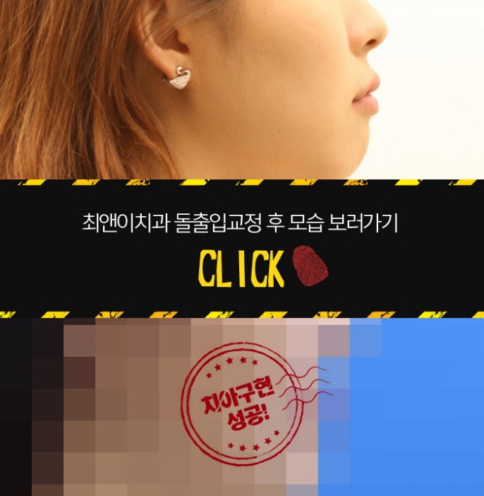 돌출입교정치과 힘들지 않으려면 관련 이미지 7