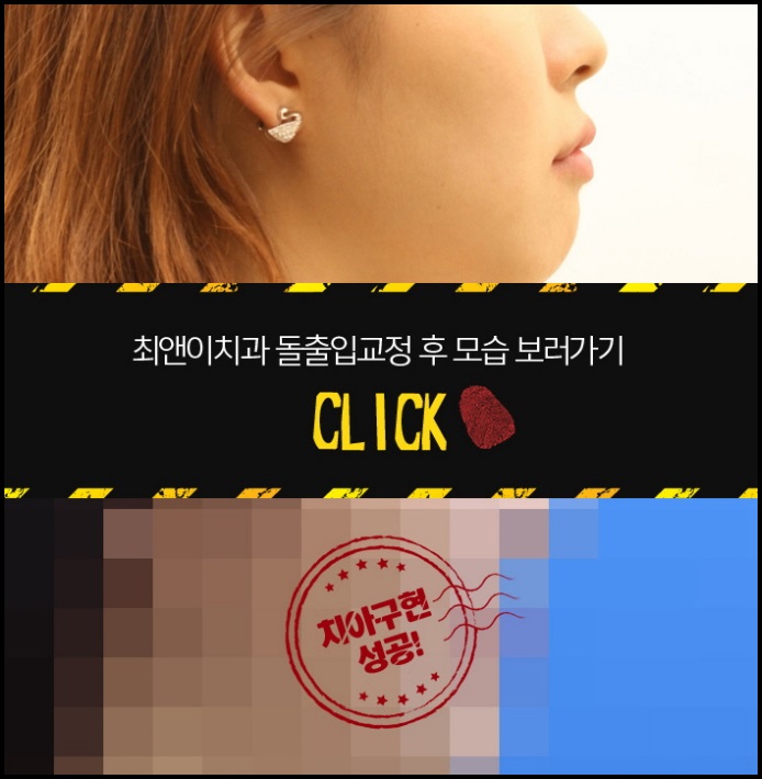 돌출입교정비용 불편하지 않도록 관련 이미지 7