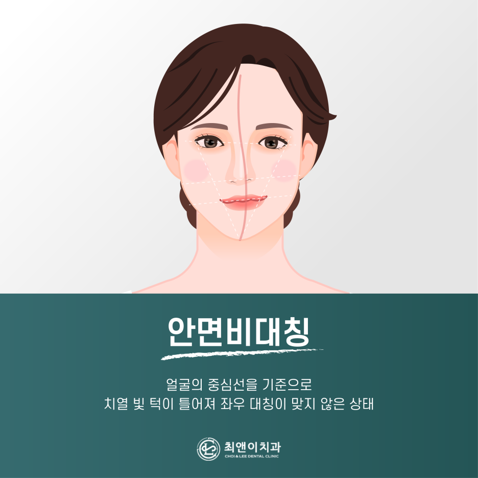 안면비대칭 증상과 원인에 대해 관련 이미지 2