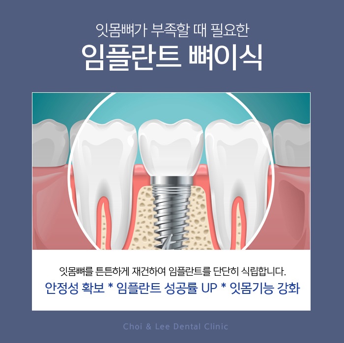잇몸뼈이식 상태파악을 우선으로 관련 이미지 2