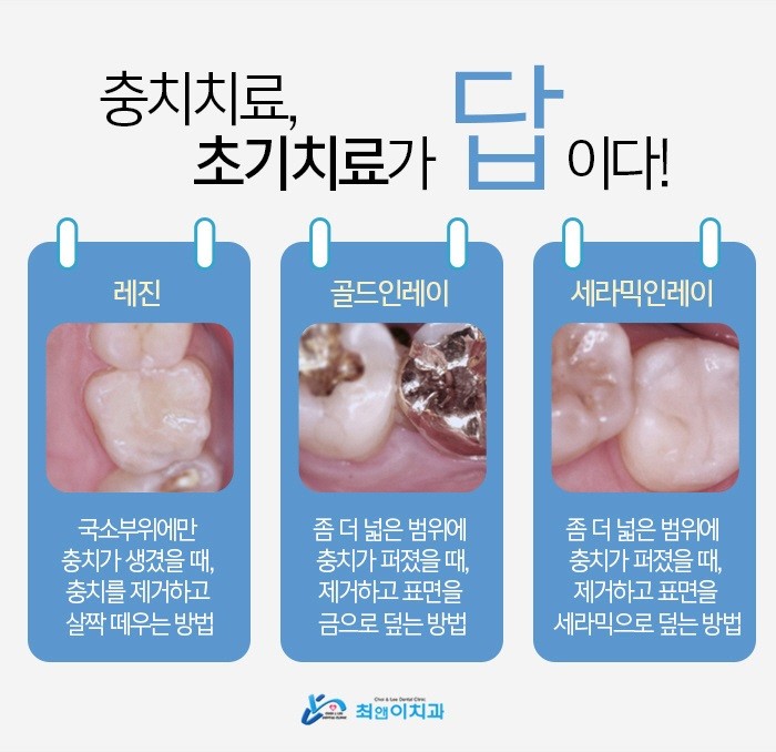 충치레진치료 아픔이 줄어들도록 관련 이미지 7