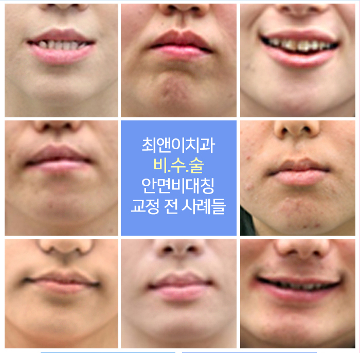 턱비대칭교정 망설이고 있나요? 관련 이미지 9