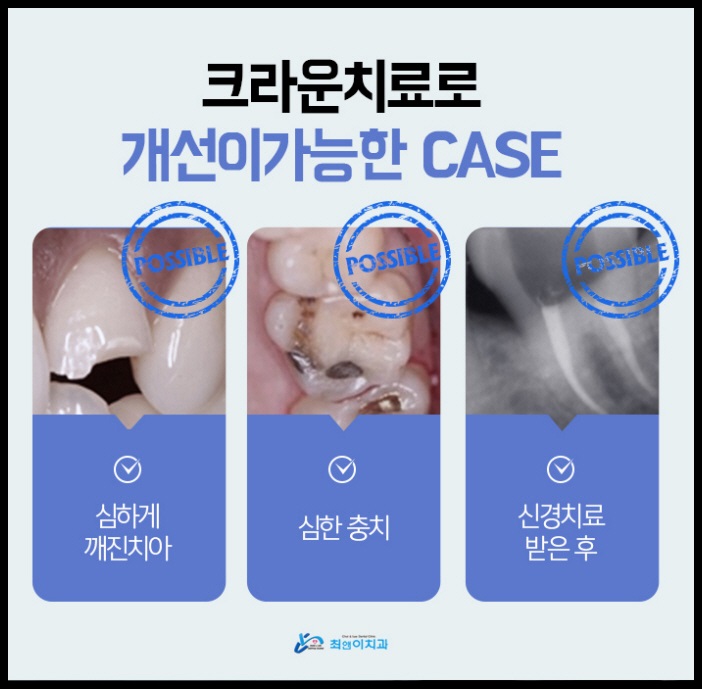 크라운치료가격 힘들지 않아야죠 관련 이미지 6