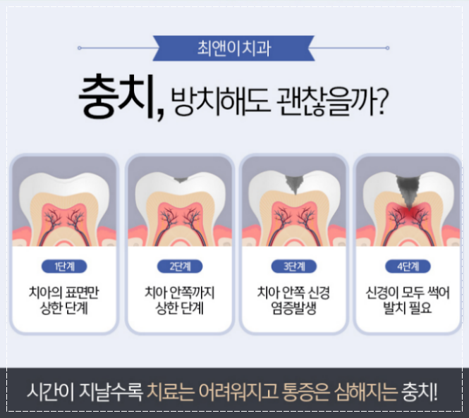 치아 레진 가격 상태에 맞춰 적합하게 관련 이미지 6