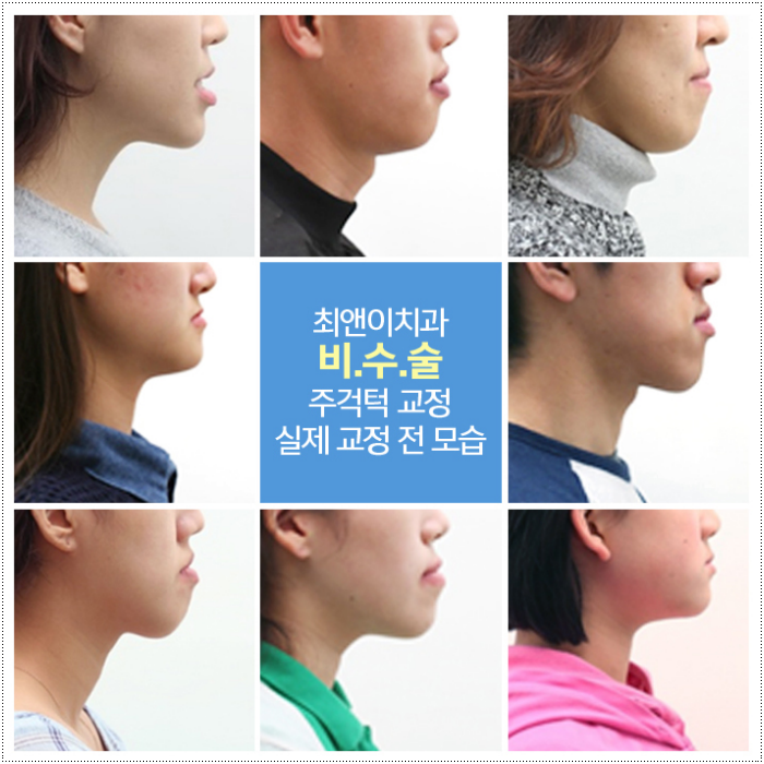 턱부정교합 걱정이 된다면 관련 이미지 4