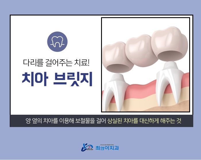앞니브릿지잘하는곳 상황에 적합하도록 관련 이미지 5