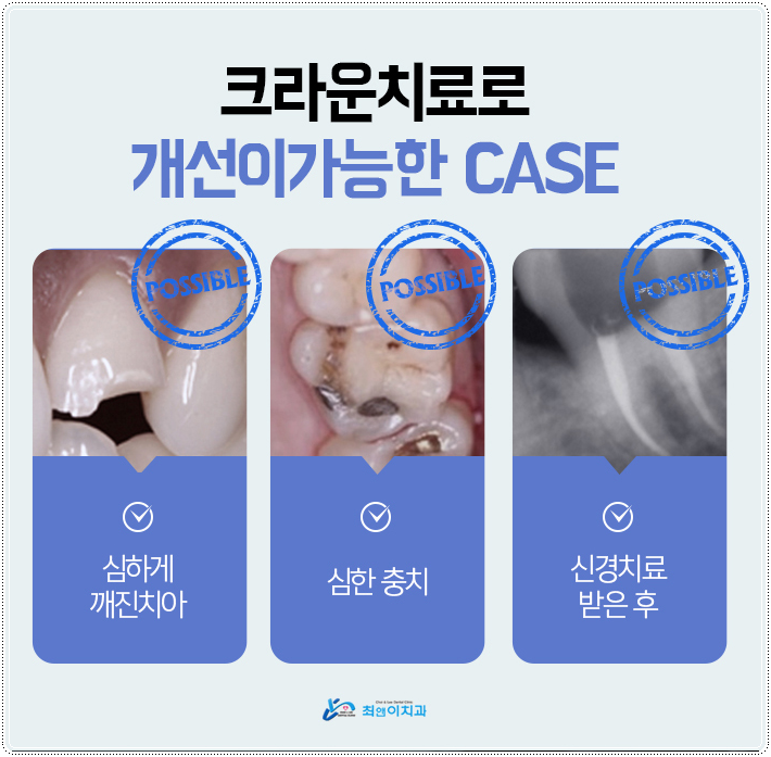 어금니깨짐 불편함이 있다면 관련 이미지 9