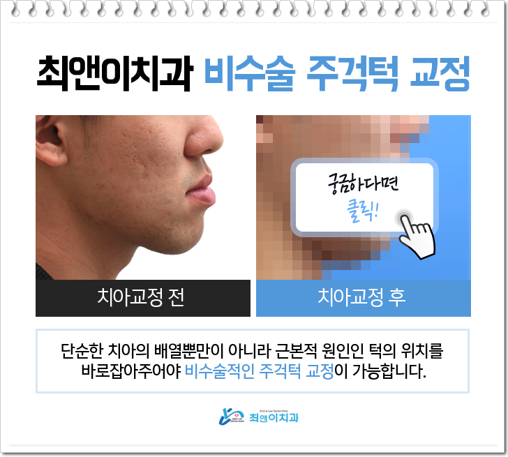 비수술주걱턱교정비용 과하지 않도록 관련 이미지 4