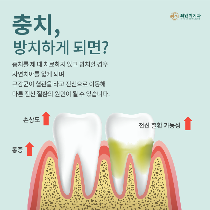 자연치아를 보존하기 위한 충치치료 방법 관련 이미지 3