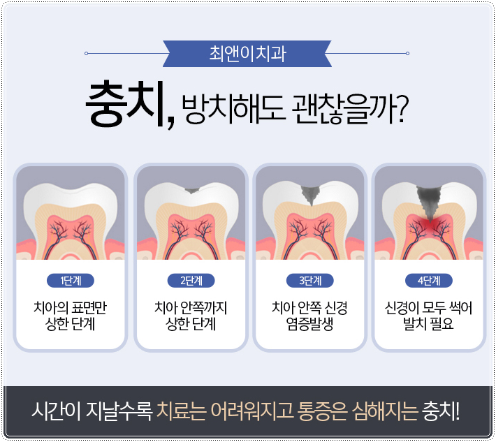 어금니깨짐 불편함이 있다면 관련 이미지 6