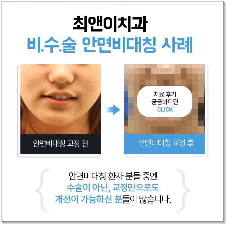 얼굴비대칭교정 비틀어져 보일 경우 관련 이미지 4