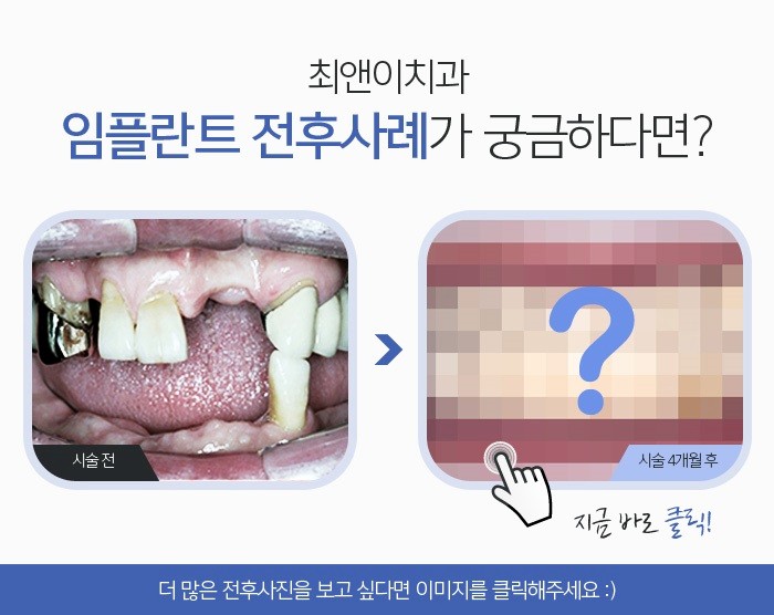 뼈이식임플란트비용 마치 내 치아처럼 관련 이미지 7