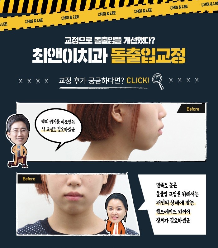 잇몸뼈돌출 치아가 원인이라면 관련 이미지 7