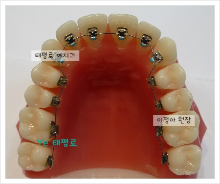 [in 치아교정과] 설측교정 + 치아교정 방송일정^^ 관련 이미지 2