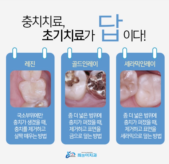 레진 치료 비용 힘들지 않도록 관련 이미지 5