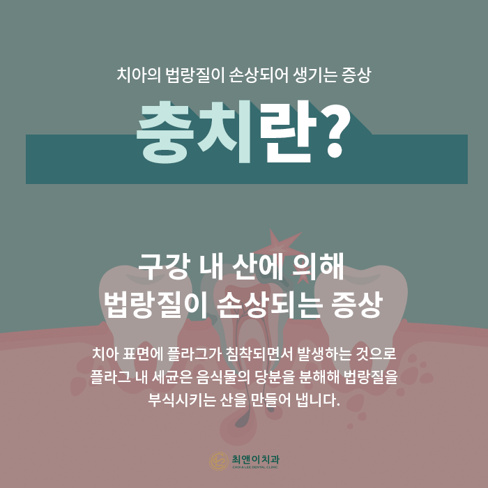 자연치아를 보존하기 위한 충치치료 방법 관련 이미지 2