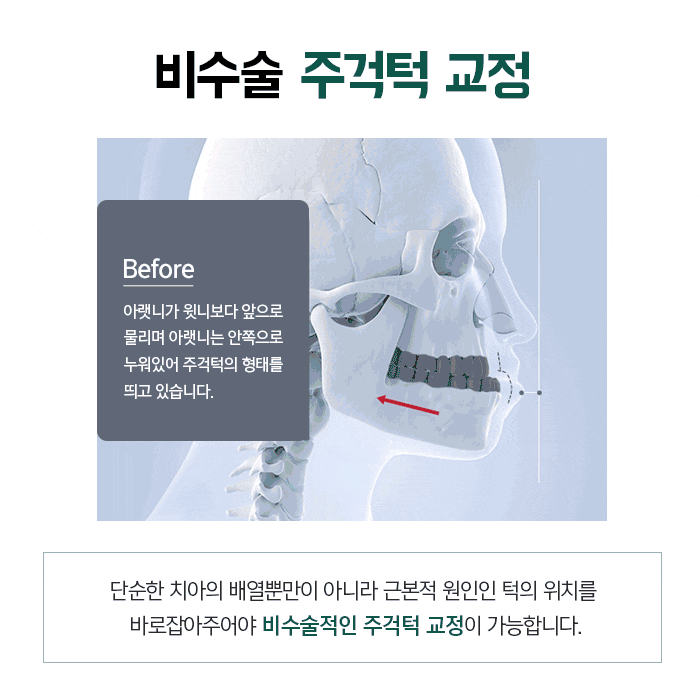주걱턱의 정의와 증상에 대해 관련 이미지 8