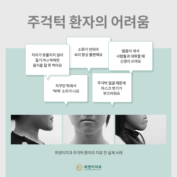 주걱턱의 정의와 증상에 대해 관련 이미지 3