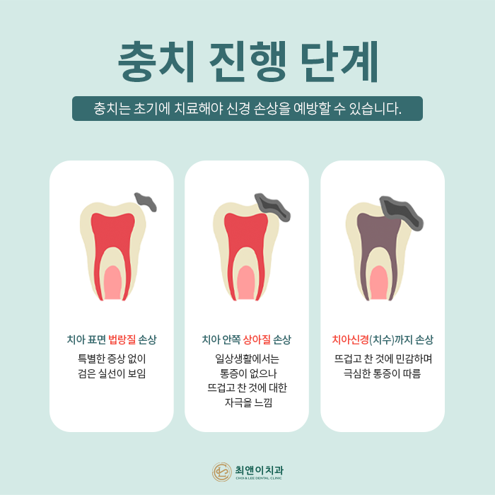자연치아를 보존하기 위한 충치치료 방법 관련 이미지 4