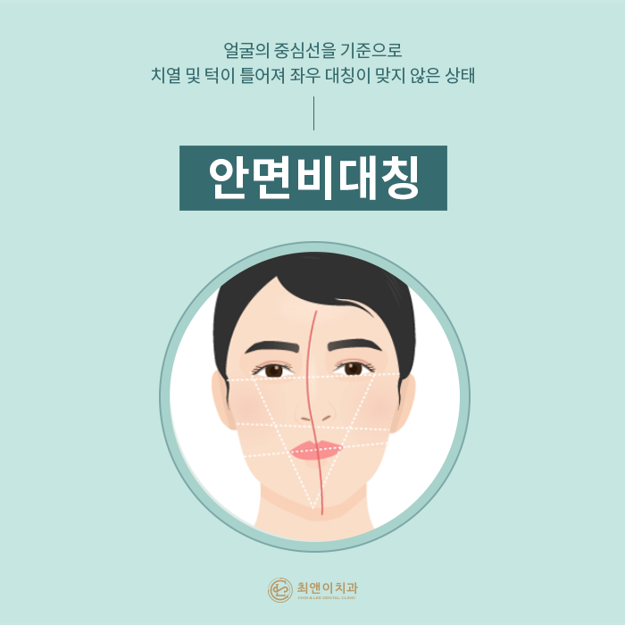 안면비대칭 증상과 원인에 대해 관련 이미지 2