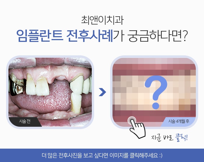 어금니임플란트가격 힘들다고 참지 말고 관련 이미지 2