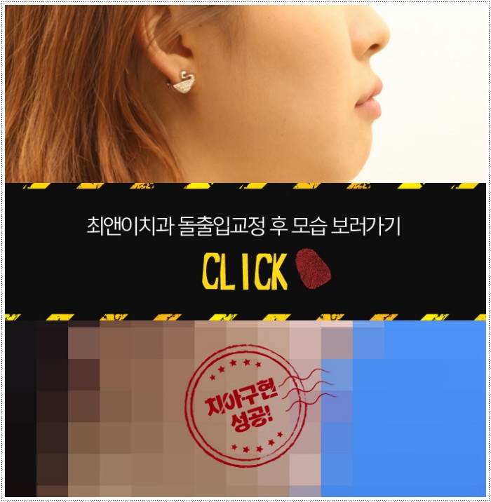 돌출입치아교정 힘들지 않도록 관련 이미지 7