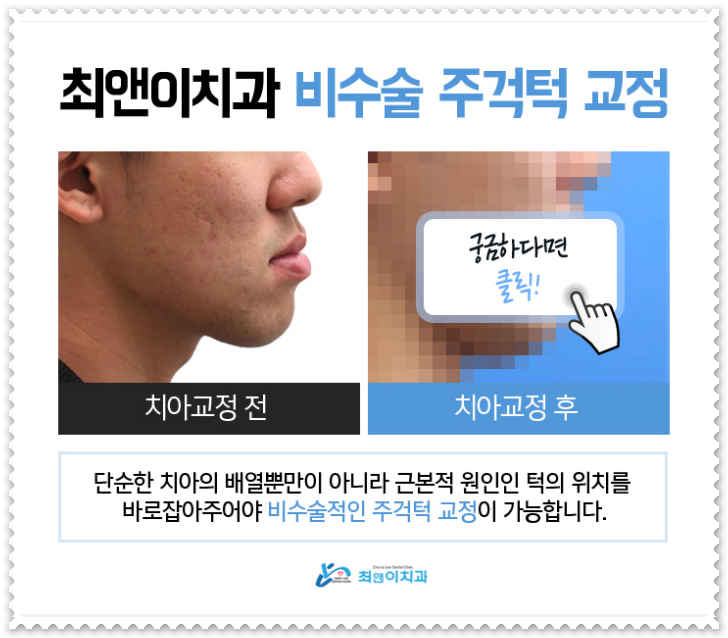 주걱턱교정 힘들지 않게 받으려면 관련 이미지 5