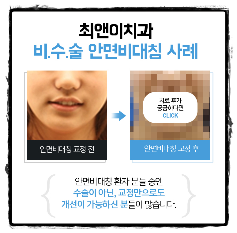 턱비대칭교정 알맞은 모습으로 바꾸자 관련 이미지 6