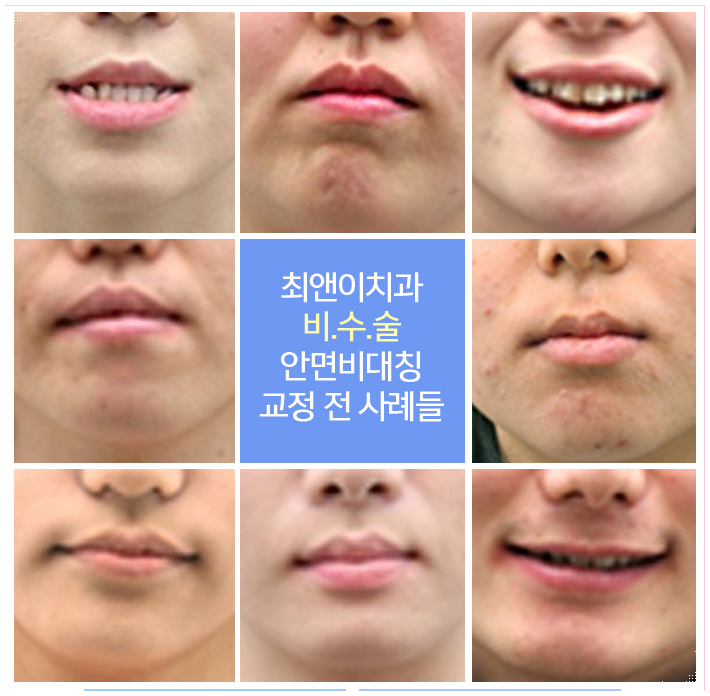 턱뼈비대칭 알맞게 잡아야죠 관련 이미지 8