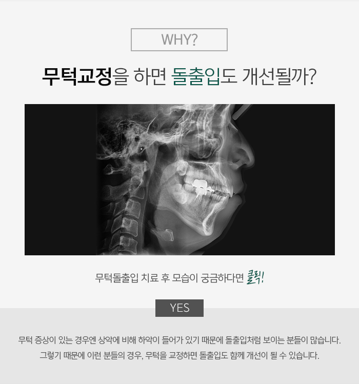 무턱 증상과 원인에 대해 관련 이미지 7