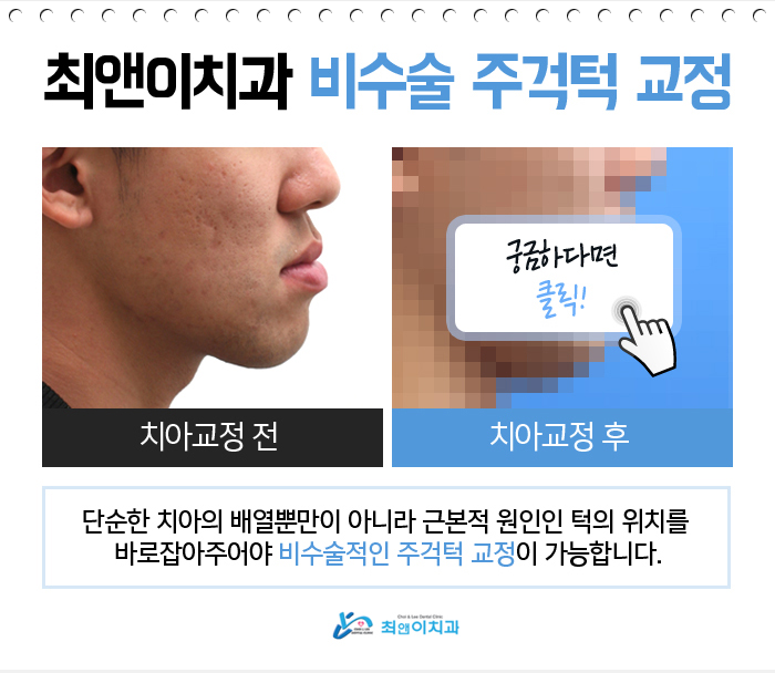 비수술주걱턱교정 알아볼까요? 관련 이미지 4