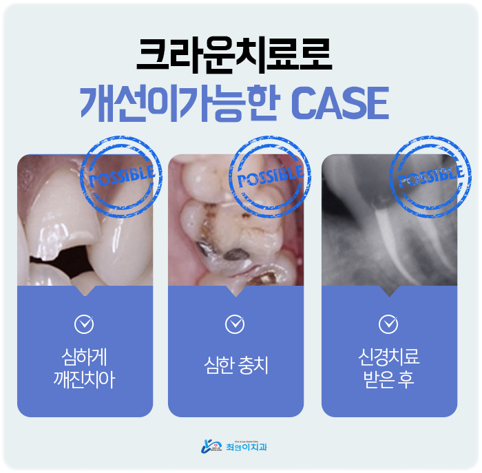 이빨깨졌을때 어쩔줄 모른다면? 관련 이미지 9