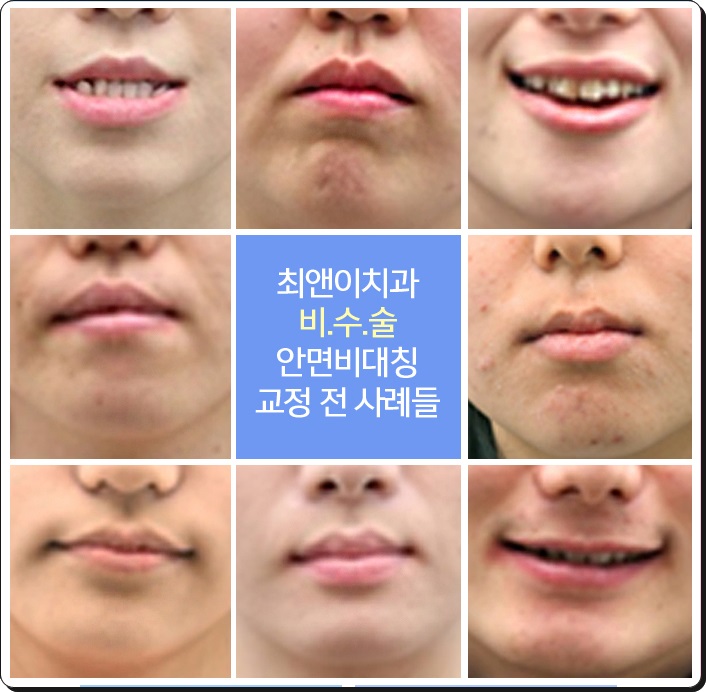 안면비대칭교정비용 밸런스가 잡히게 관련 이미지 8