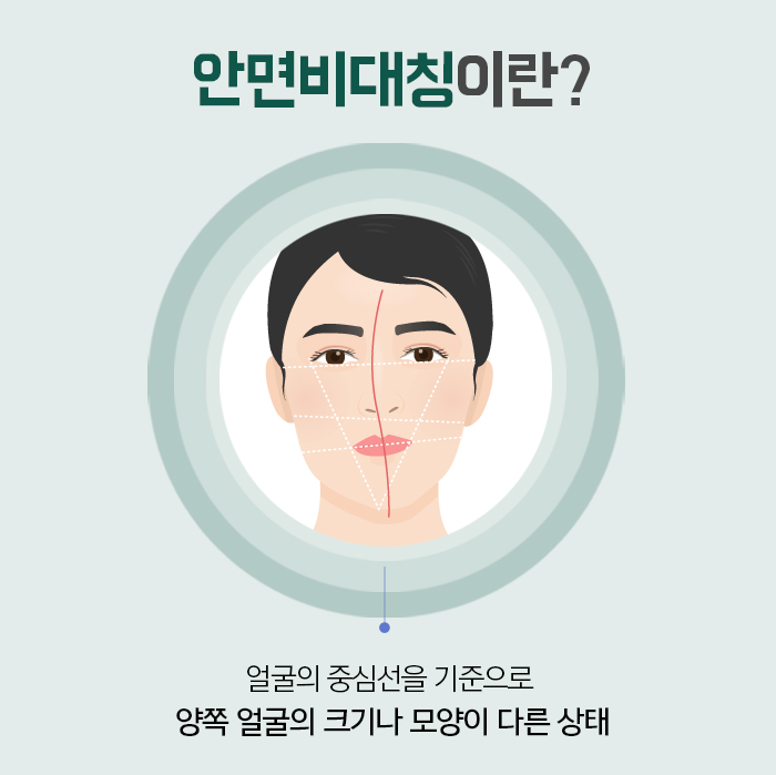 안면비대칭 증상과 원인에 대해 관련 이미지 3