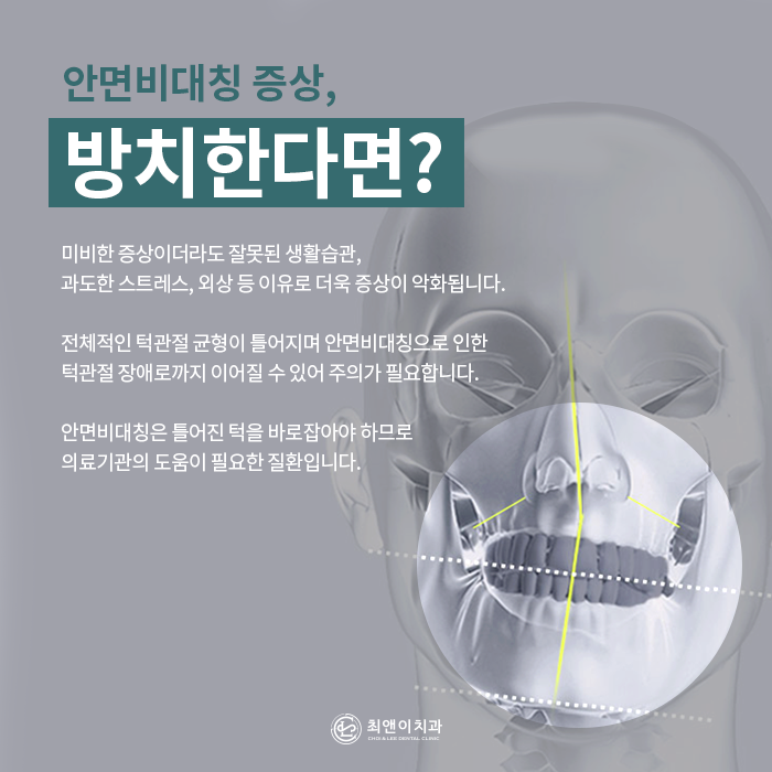 안면비대칭 증상과 원인에 대해 관련 이미지 4