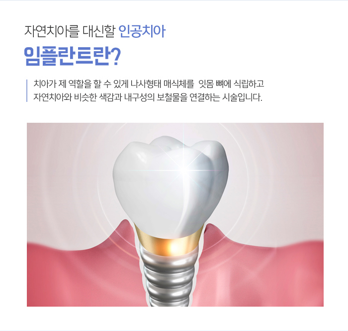 치아를 상실했을 때, 기능을 회복시켜주는 임플란트 관련 이미지 4