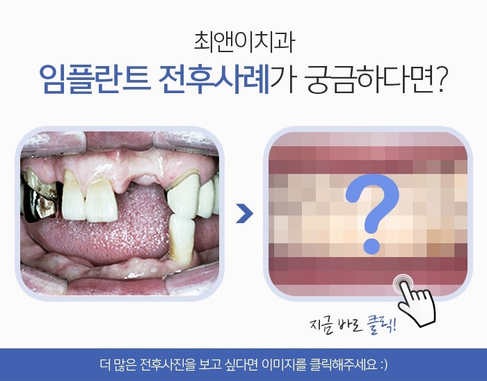 서울임플란트잘하는치과 찾아가기 위해서 관련 이미지 6