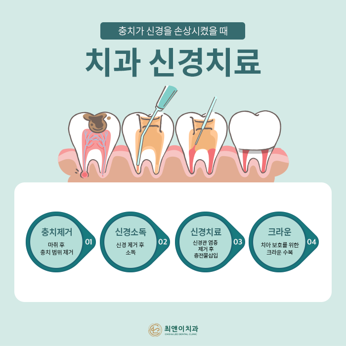 자연치아를 보존하기 위한 충치치료 방법 관련 이미지 8