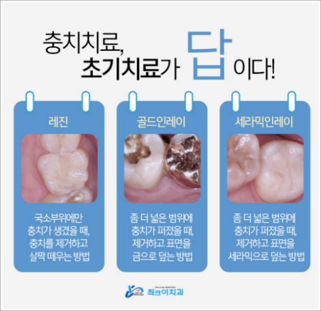 치과 레진 비용 찾아보고 계신다면 관련 이미지 7