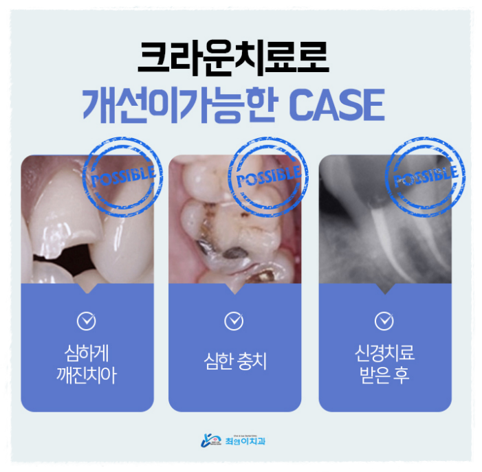 앞니부러짐 허전함이 크다면 관련 이미지 9