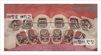 [in 치아교정과] 8월 설측교정 + 치아교정 방송일정^^ 관련 이미지 2