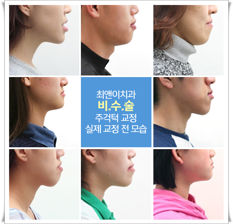 비수술주걱턱교정 힘들지 않고자 하려면 관련 이미지 4
