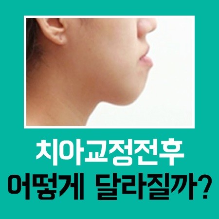 서울교정치과추천 힘들지 않도록 관련 이미지 1