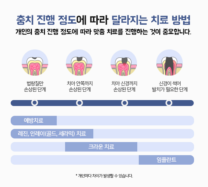 자연치아를 보존하기 위한 충치치료 방법 관련 이미지 6