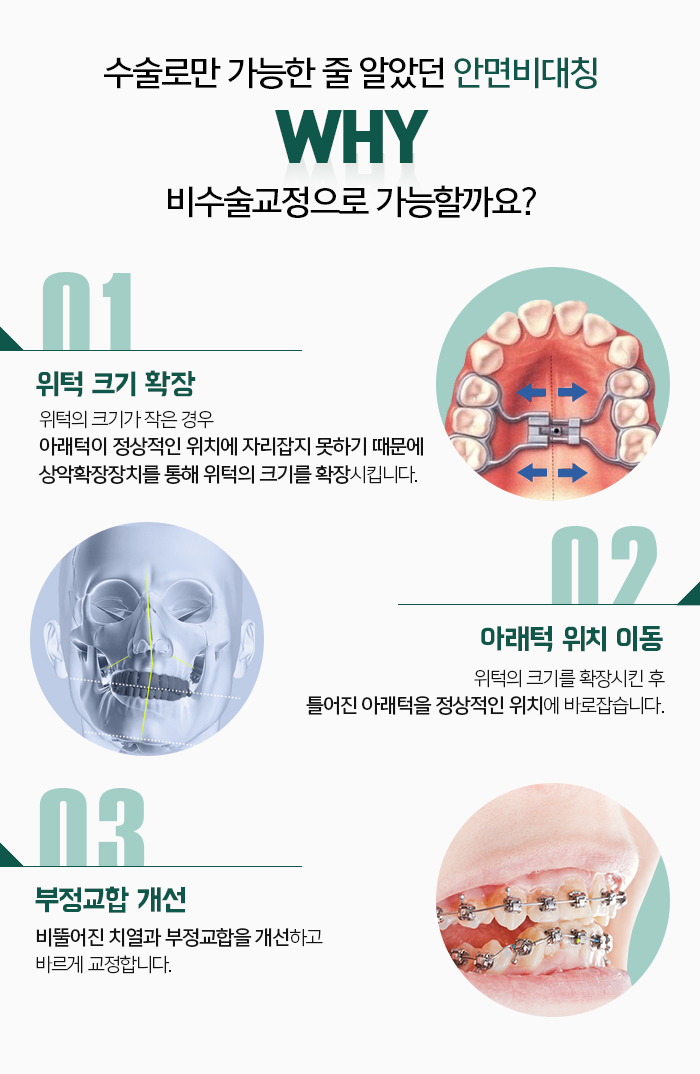 주걱턱의 정의와 증상에 대해 관련 이미지 7