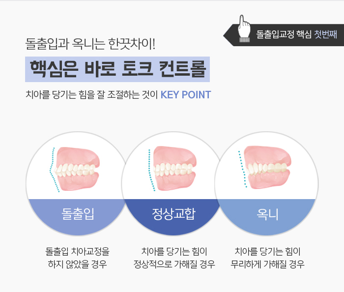 돌출입의 정의와 진단하는 방법에 대해 관련 이미지 9