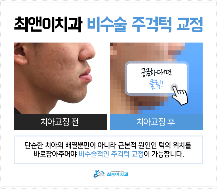아래턱교정 균형이 잡히게 관련 이미지 4