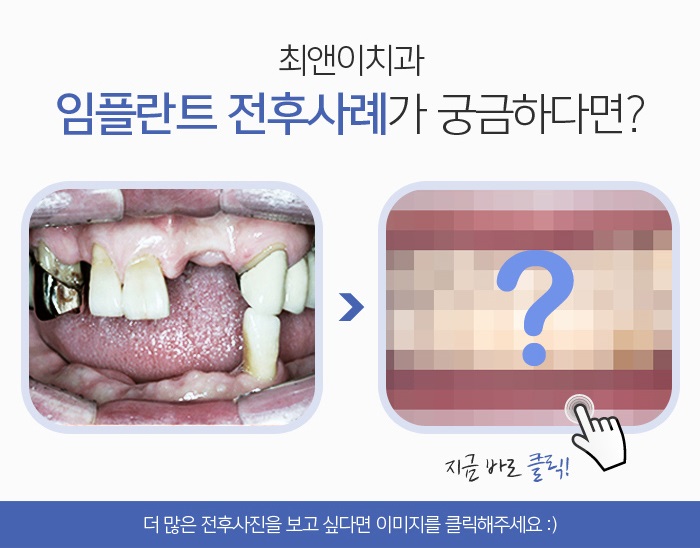 잇몸뼈이식 상태파악을 우선으로 관련 이미지 7
